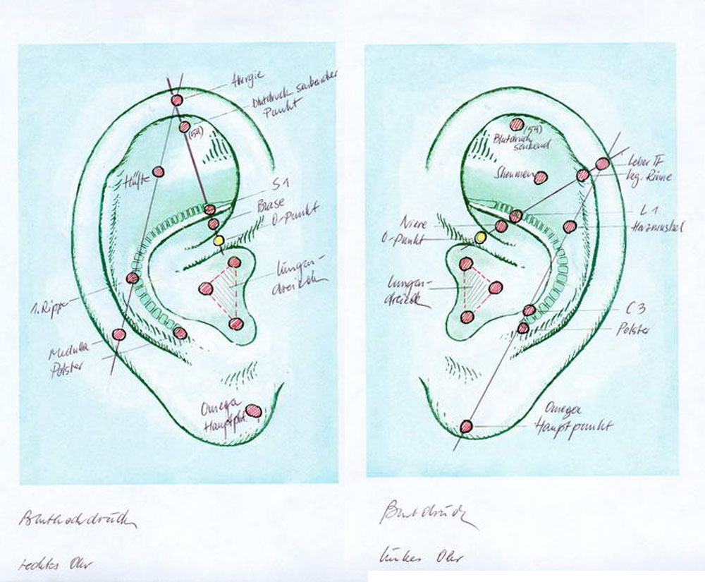 Ohrakupunktur Bluthochdruck
